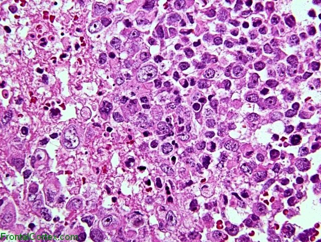 Atypical teratoid tumor x400